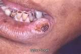 lipcancerpicture2.jpg
