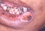 Oral Cancer